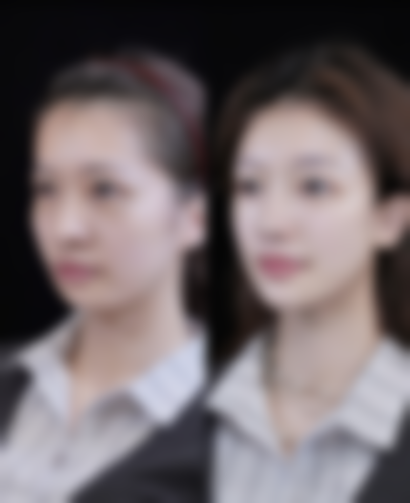 一、哪做双眼皮的手术好之手术方式选择