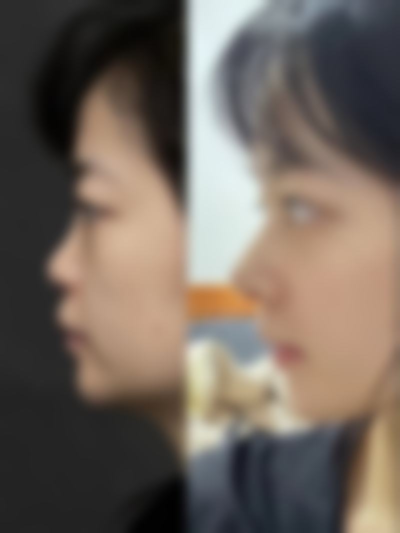 三、眼袋有泪沟的治疗方案选择