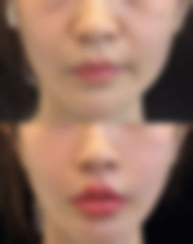 面部抽脂有什么后遗症总结