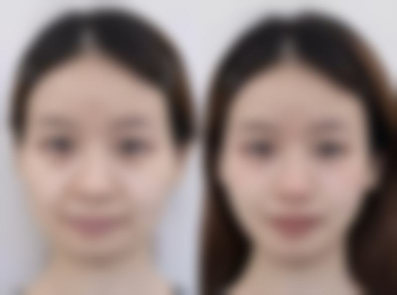 一、熬夜与眼袋的关联剖析