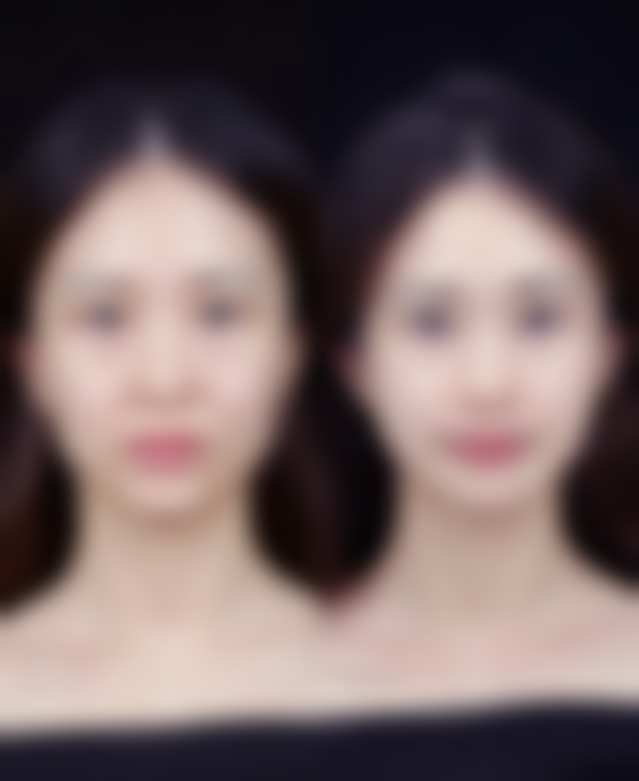 五、做双眼皮一个月能否修复的总结与建议