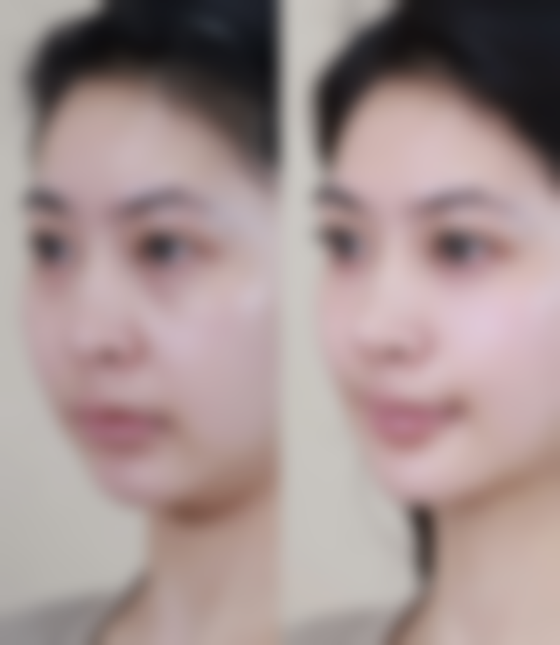 三、溶脂针消除眼袋的风险