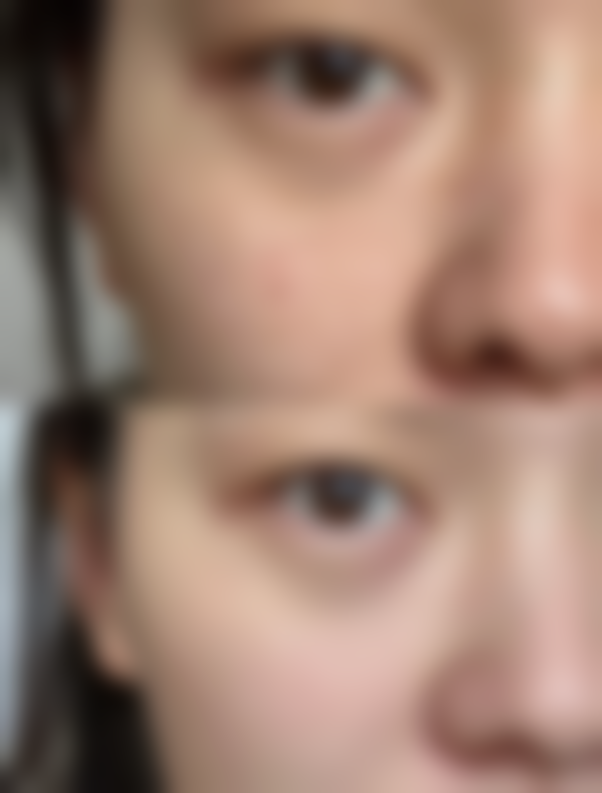 {做双眼皮一个月能恢复吗？手术方式、个人体质揭秘恢复真相，附恢复图片参考 