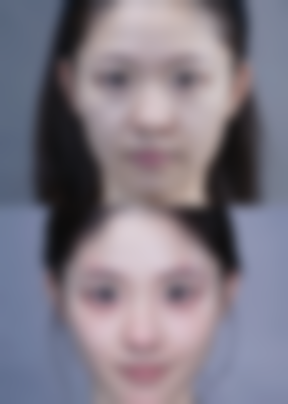 三、做了隆鼻手术后的美学相关小贴士