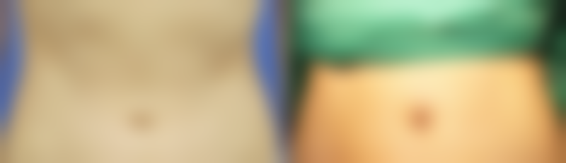 二、影响去眼袋手术安心的因素