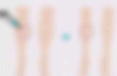 三、环形吸脂手术的感染与血肿风险