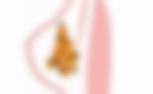 六、如何追求小时候割双眼皮长大后的理想成效