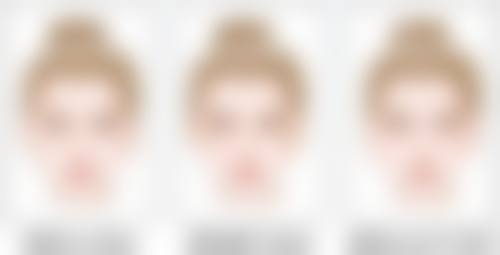 三、激光治疗陈旧疤痕的成效