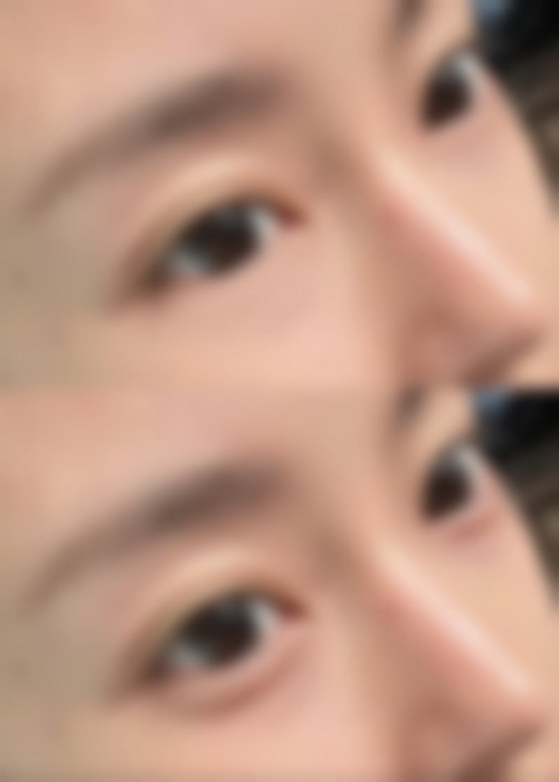 四、烧伤疤痕怎么冶疗之压力治疗