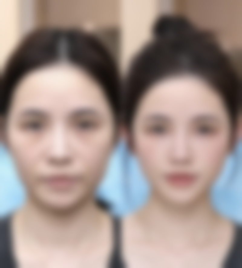 一、激光治疗陈旧疤痕的原理