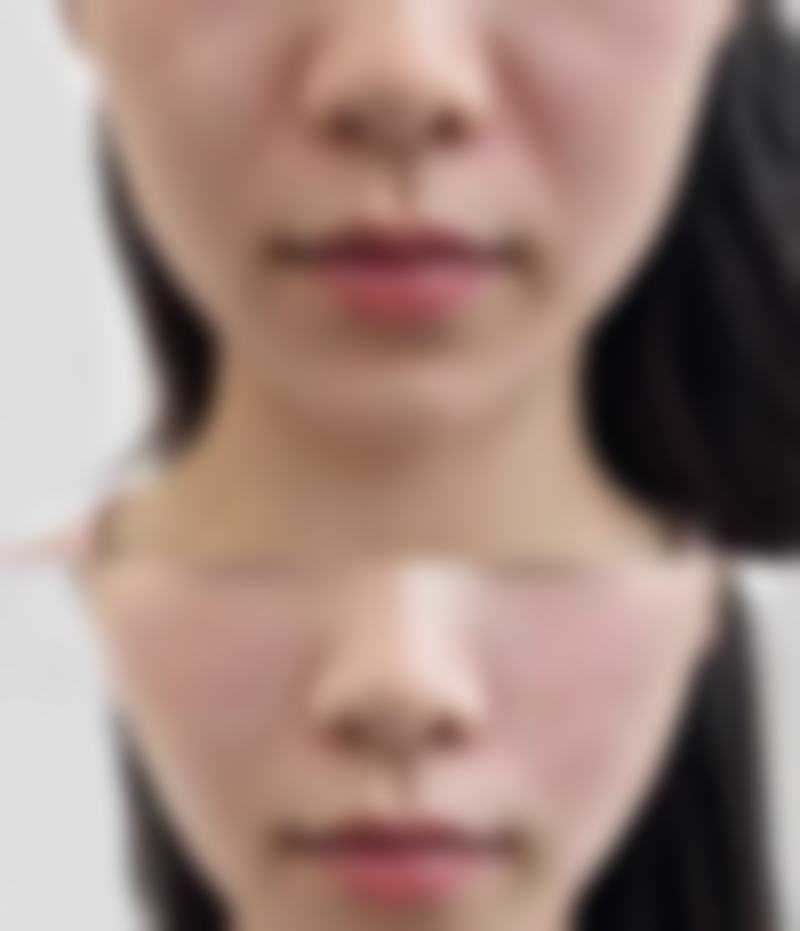 一、双眼皮没做好二次调整的时间建议