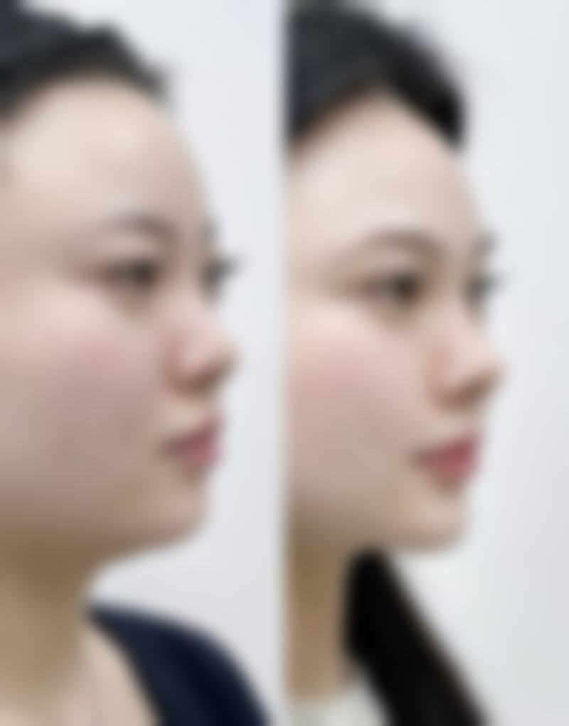 激光能不能去除陈旧疤痕？了解适用情况、效果及护理，让疤痕改善不是梦！ 