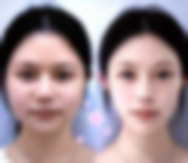 二、环形吸脂手术可能引发的身体外观问题