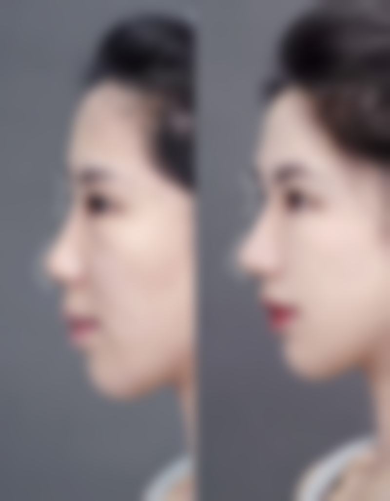 一、割完双眼皮早期为啥不建议侧睡