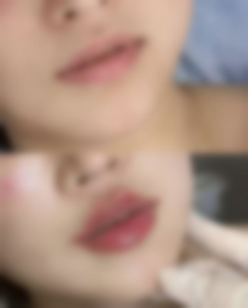 三、不同质量假体的保持时间差异