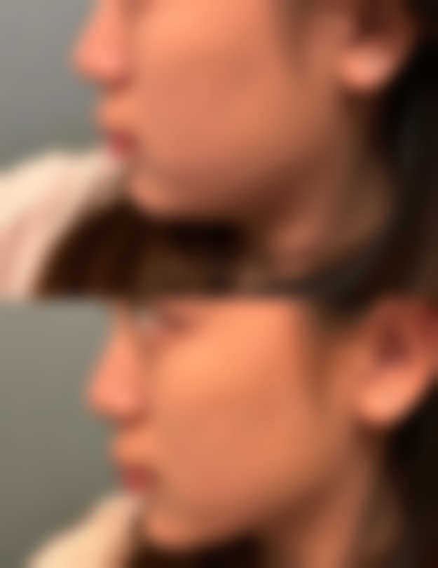 一、烫伤老疤痕去除前的评估