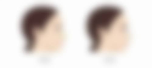 二、不同术式的消肿时间