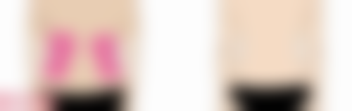 五、如何降低腹部吸脂的危害