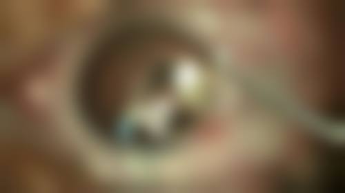 四、子宫疤痕憩室的检查与治疗