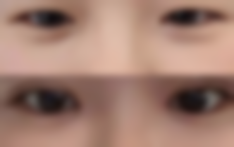 四、修复时间与复查安排:祛眼袋手术后怎么护理修复的快的监测保护