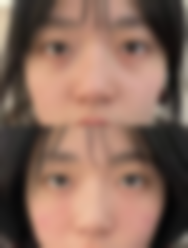 一、脸部吸脂的基本原理