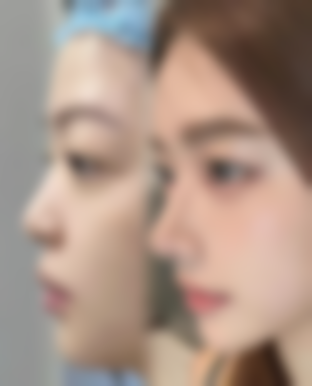 什么叫子宫疤痕憩室？了解其成因、症状及对生育的影响很重要！ 