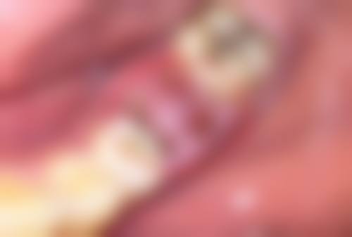 一、六十岁做双眼皮的可行性分析