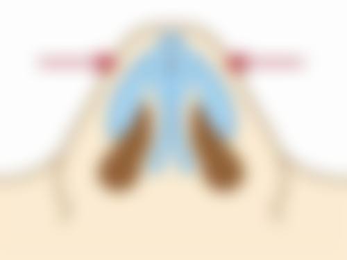 二、为什么一只双眼皮会变成三眼皮：解决方案与步骤