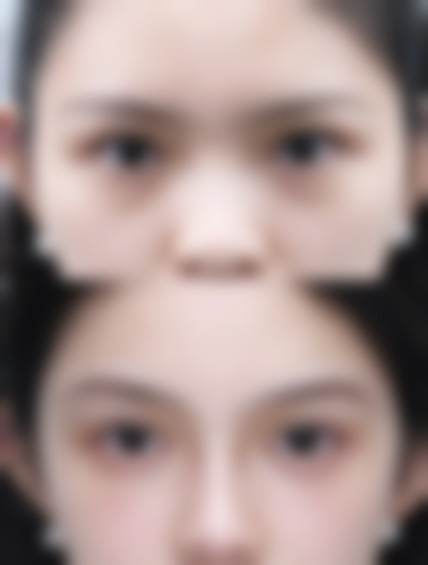 三、为什么一只双眼皮会变成三眼皮：美学提示