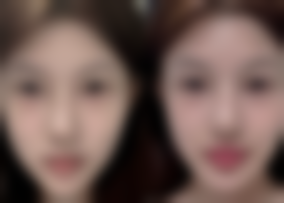 一、了解疤痕增生