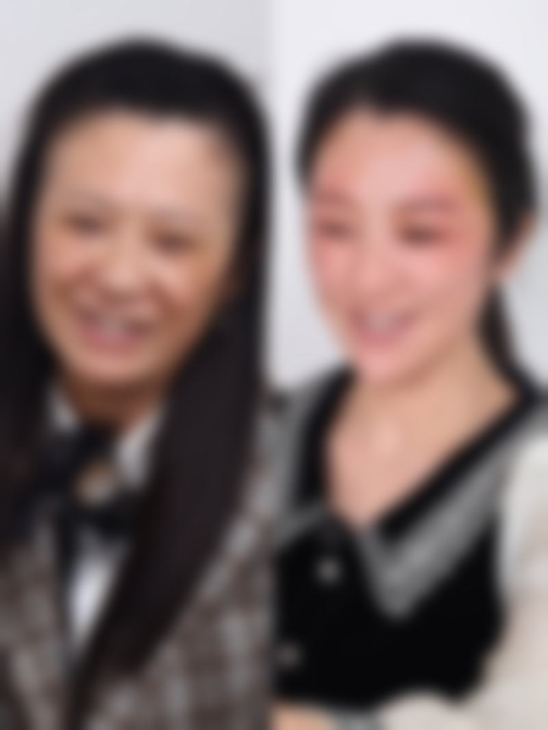 {埋线双眼皮一个宽一个窄能恢复好吗？了解恢复因素与方法助你实现双眼对称