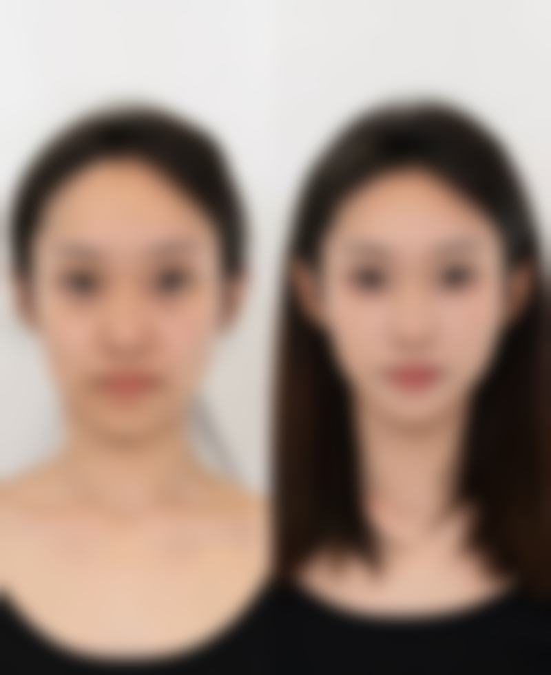 五、为什么一只双眼皮会变成三眼皮：及时就医情况