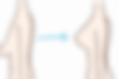 一、肋骨隆鼻吸收的基本情况