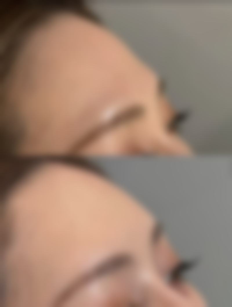 五、应对肋骨隆鼻吸收的心态和注意事项