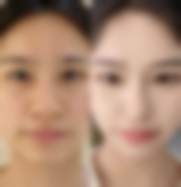 一、点痣留下红色疤痕要多久才好的常见情况