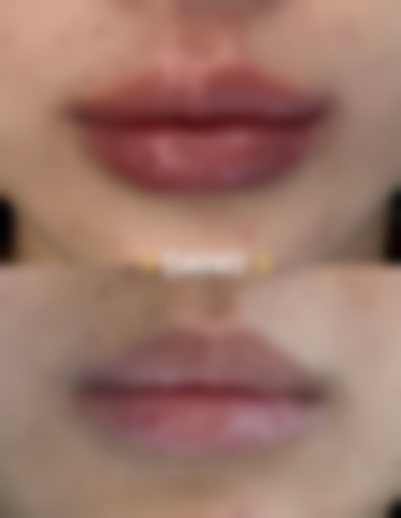 六、疤痕修复实例分享