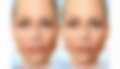 三、割完双眼皮一直流眼泪正常吗？应对方式大揭秘