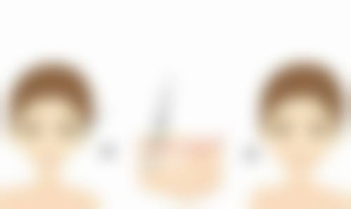 一、什么是复合式隆胸