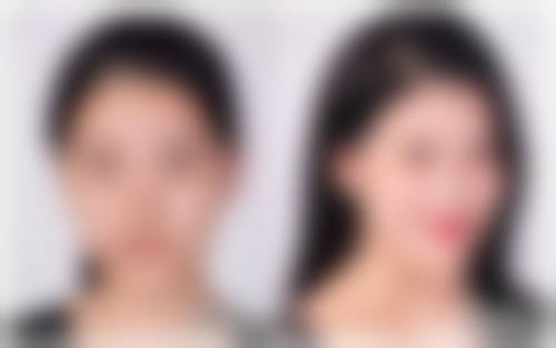 二、割完双眼皮一直流眼泪正常吗？正常与异常症状对比