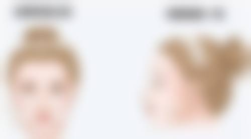 {什么是复合式隆胸手术：结合假体与脂肪，打造自然饱满胸部的奥秘 