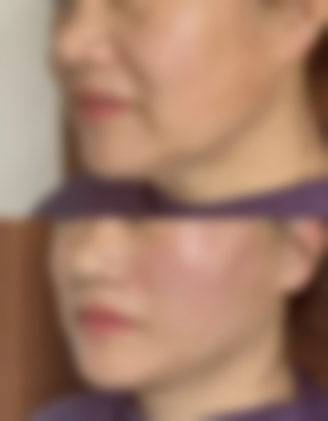 五、抽脂减肥相关的注意事项和风险提示