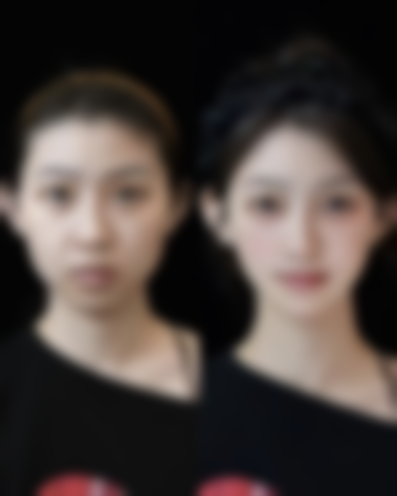 {激光修复疤痕多久做一次比较好？专家揭秘影响间隔时间的关键因素 