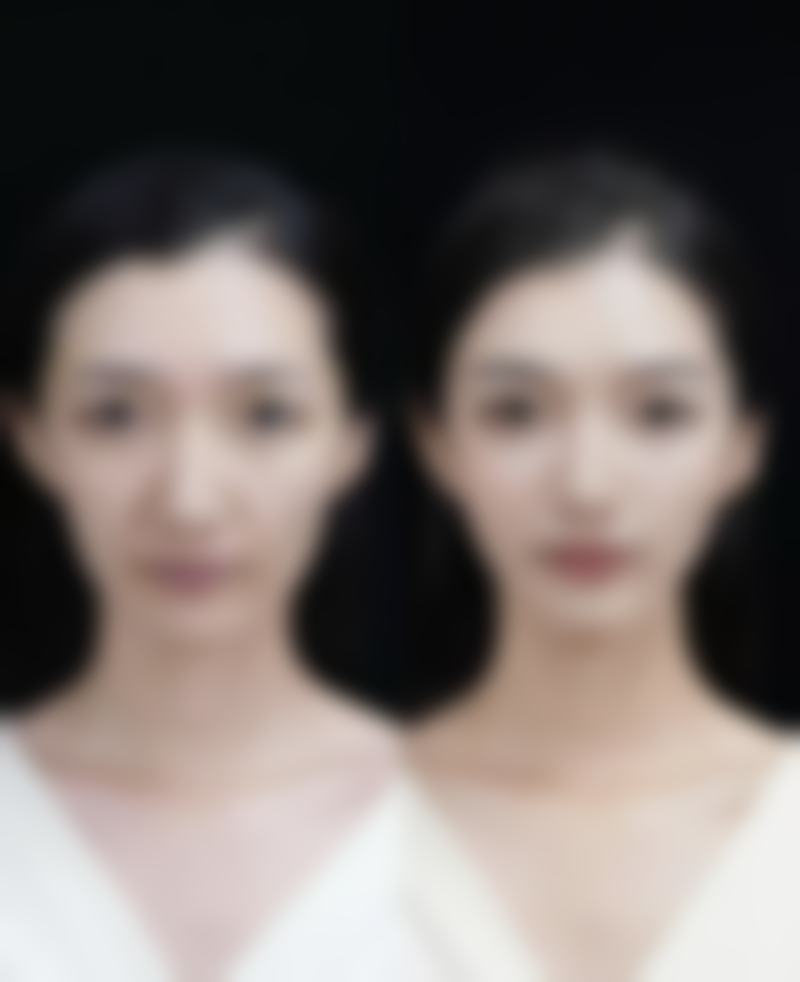 一、激光修复疤痕的常规间隔时间