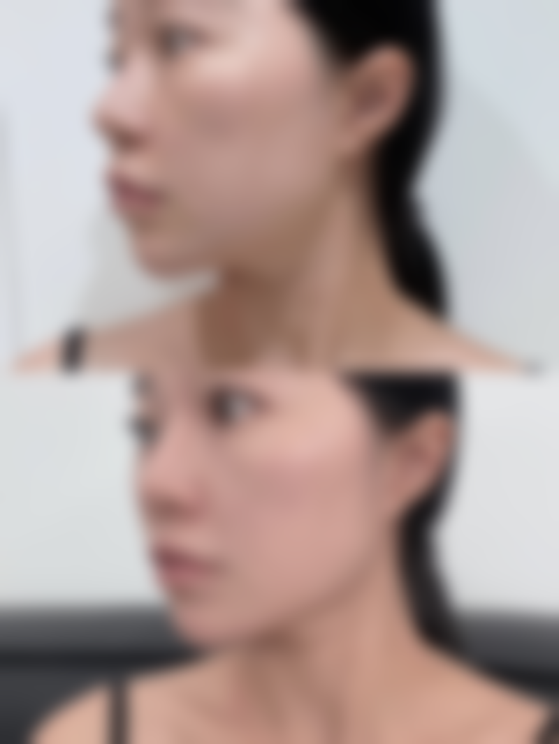 二、应急消肿方案