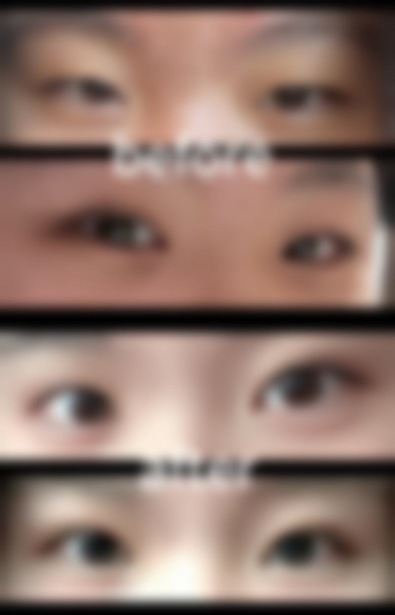 三、激光治疗眼袋需注意的问题