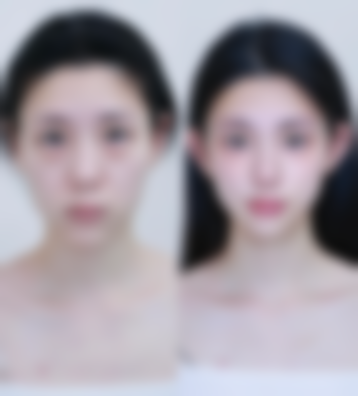 一、了解眼袋碰肿的原因与危害