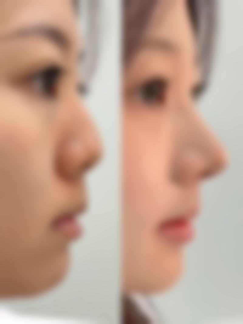 一、肋骨隆鼻能管一辈子吗？答案存疑