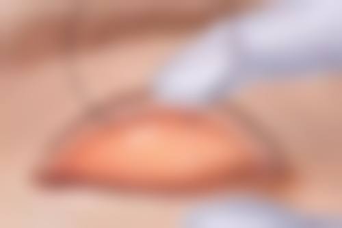 三、怎么样能消除眼袋和黑眼圈之激光及物理治疗