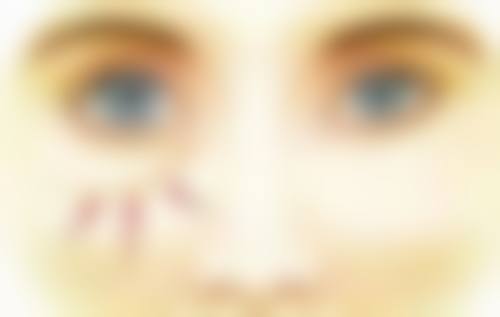 五、做双眼皮全切多久能好的总结