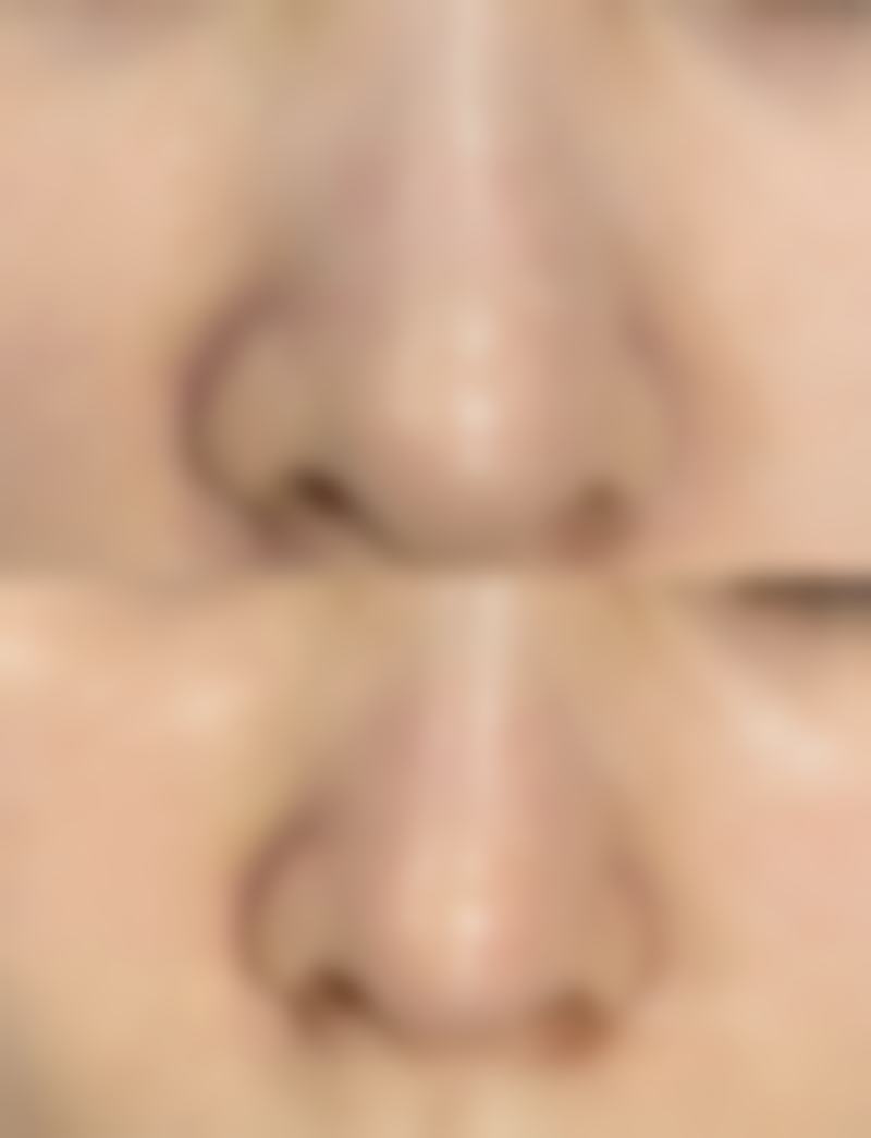 一、隆胸后怎么修复快之术后护理核心建议